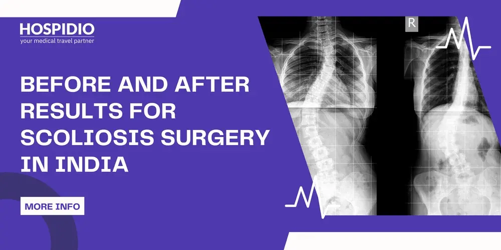 Before and After Results For Scoliosis Surgery in India