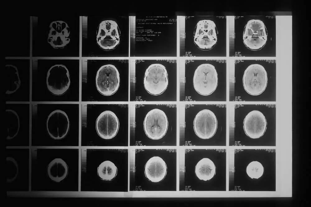 Brain Tumor Surgery 
