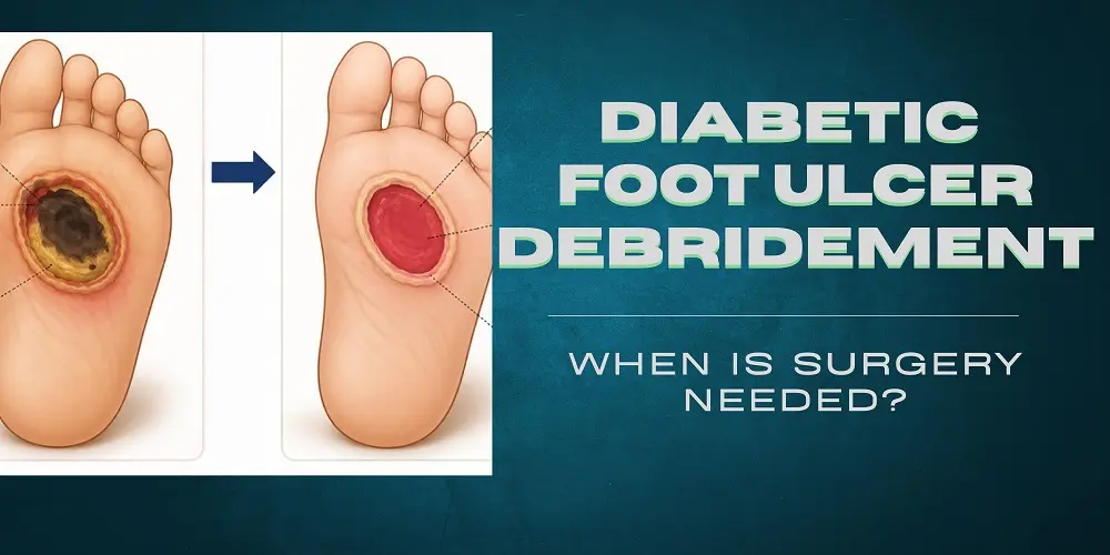 Diabetic Foot Ulcer Debridement: When Is Surgery Needed?