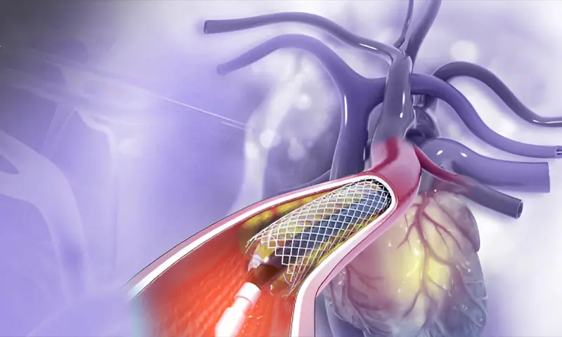 Angioplasty 
