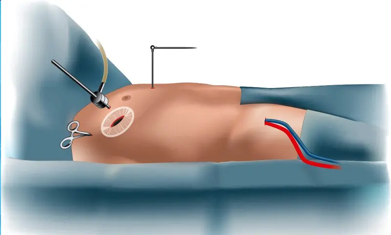 ASD Closure Surgery 